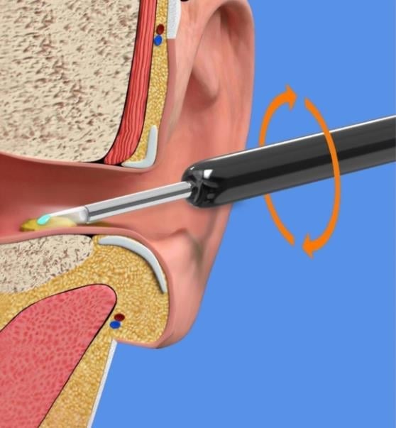 Clean Earwax - Wi -Fi Visible Wax Elimination Spoon,USB 1080P HD Load Otoscope